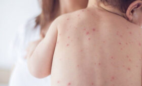 Вітряна віспа: що це, причини виникнення і як її лікувати