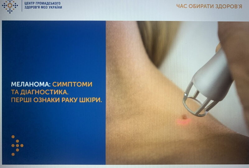 МЕЛАНОМА: СИМПТОМИ, ДІАГНОСТИКА ТА ПРОФІЛАКТИКА