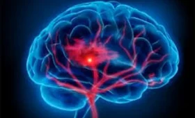 Знай ознаки інсульту