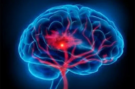 Знай ознаки інсульту